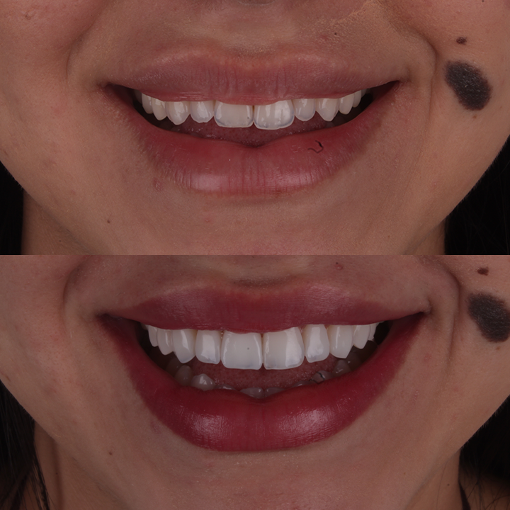 Antes e depois de lentes em resina