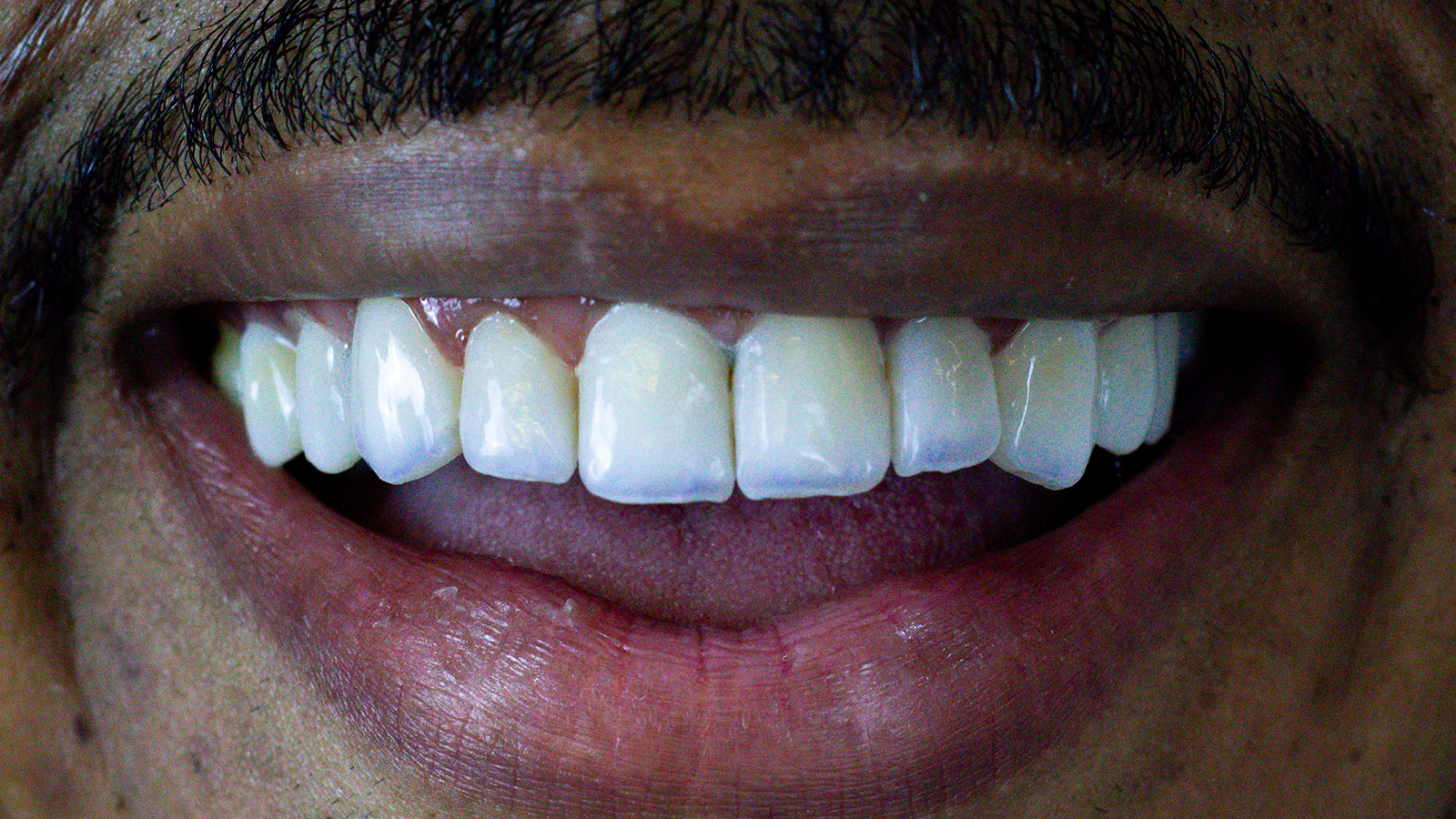 Depois do procedimento de lentes em resina