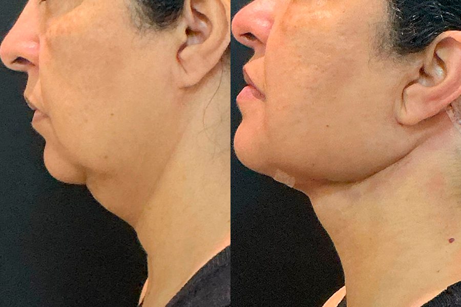 Registro 3 de lipo de papada