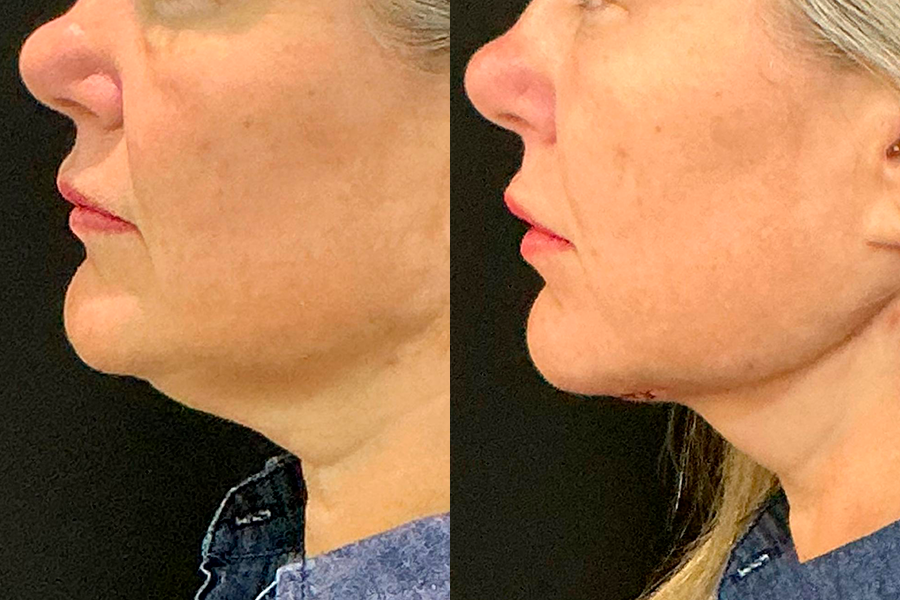 Registro 2 de lipo de papada