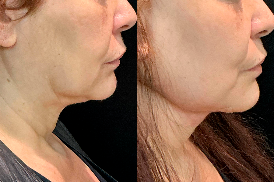Registro 1 de lipo de papada
